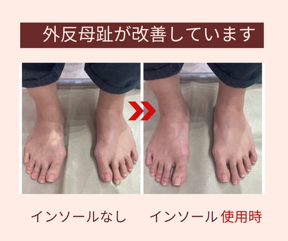 外反母趾にオーダーメイドインソール｜沖縄那覇