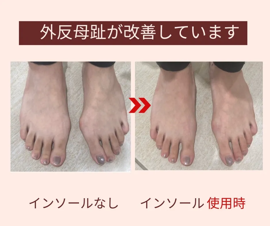 外反母趾にオーダーメイドインソール｜沖縄那覇