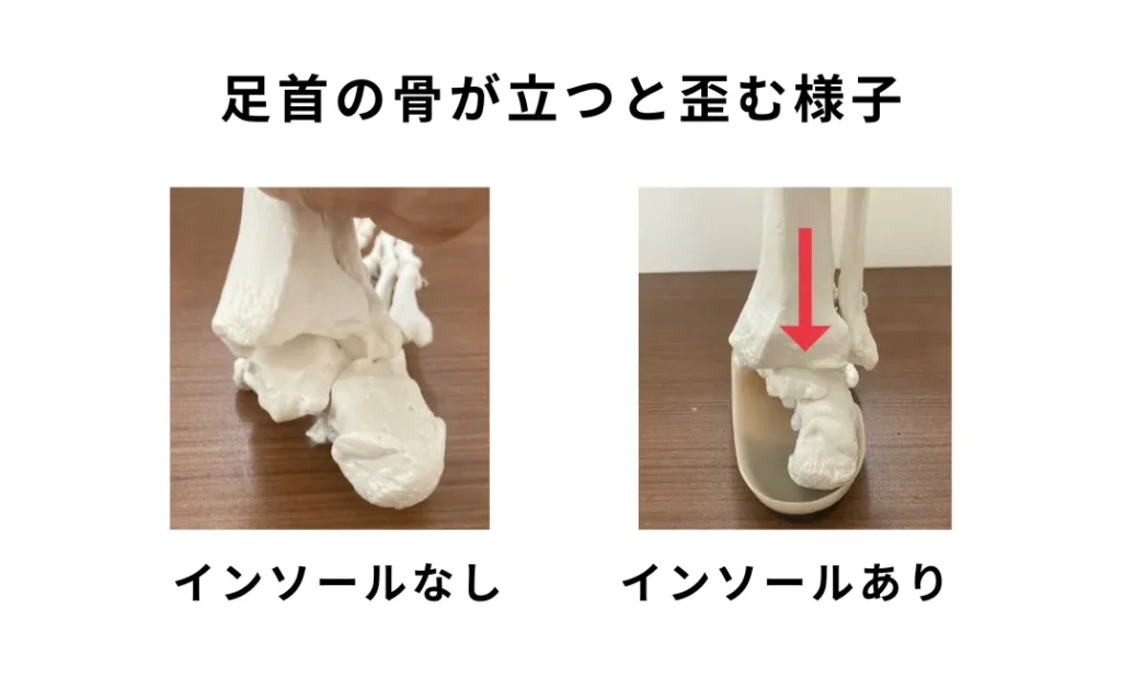 外反母趾にオーダーメイドインソール｜沖縄那覇