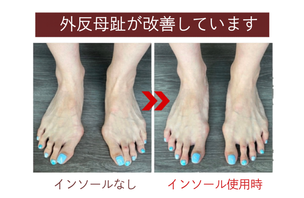 外反母趾にオーダーメイドインソール｜沖縄那覇